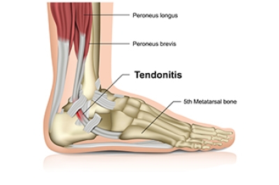 Causes and Prevention of Achilles Tendonitis